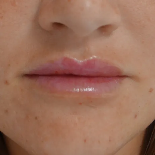 Image after