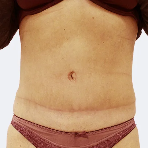 Image after