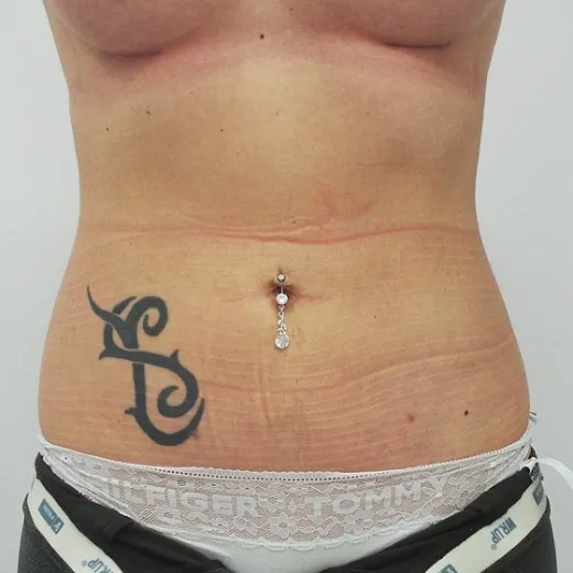 Image after
