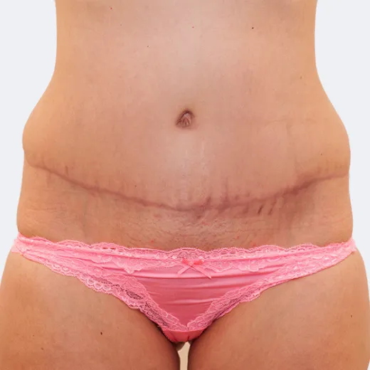 Image after