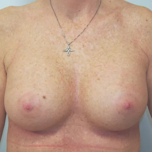 Image after