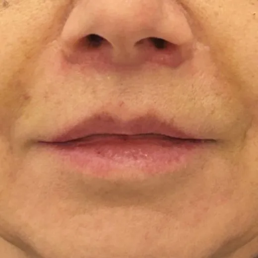 Image after