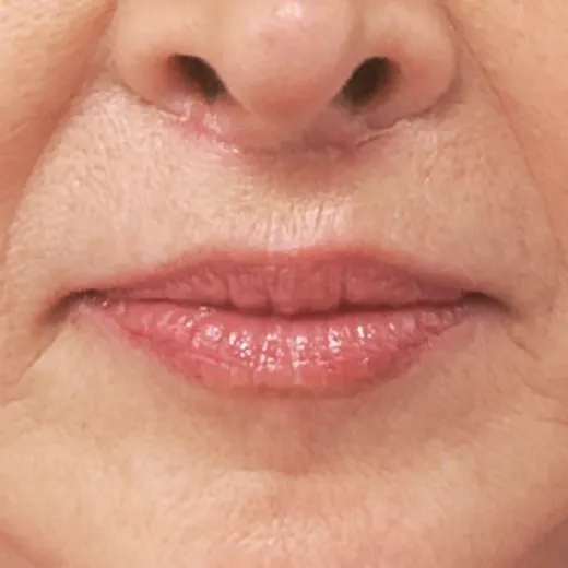 Image after